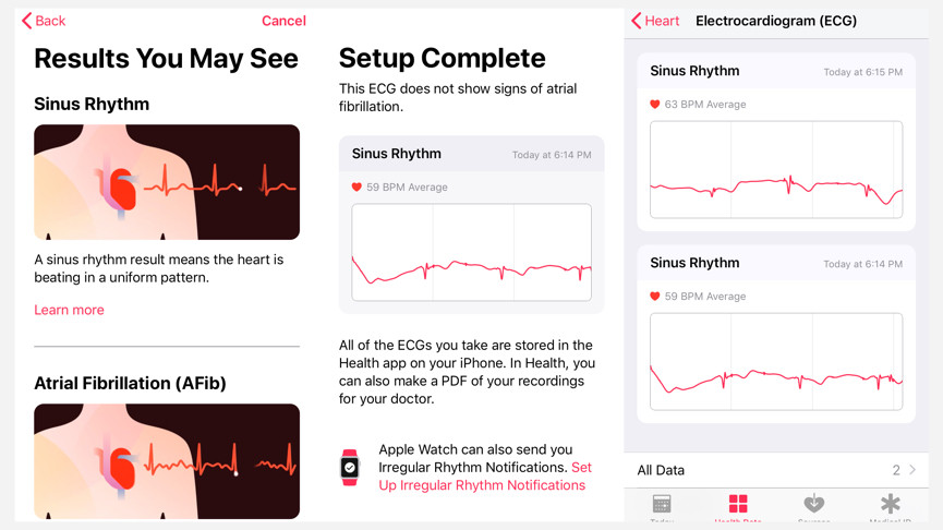 Apple Watch ECG in app